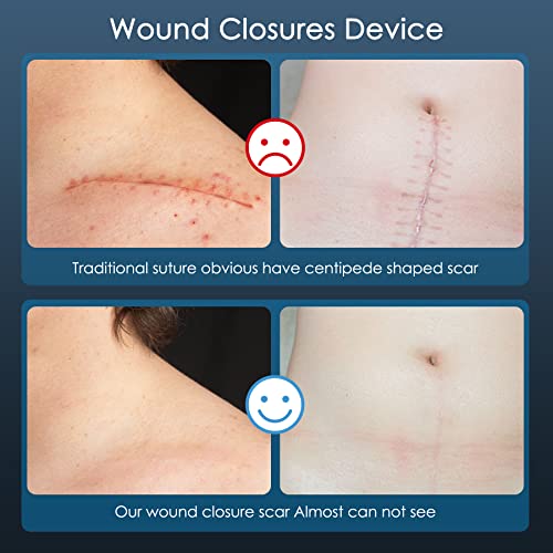 Wound Closure Strip, Sterile First Aid Kit,Zip And Stitch Suture-Free, Adhesive Stitch Emergency Close Wound Device, Flexible Fabric Adhesive Bandages For Wound Care & First Aid Skin Injury (4 Pcs) #TOP2