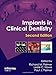 Implants in Clinical Dentistry