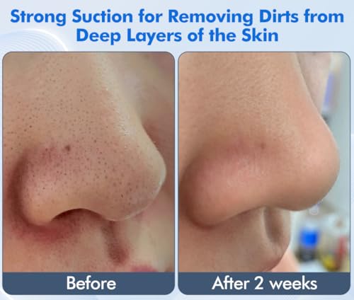 Lrbsule Limpiador Facial Electrico 2 en 1, Succionador de Puntos Negros, 5 Modos de Vibración, 3 Niveles de Succión, IPX7 Quita Puntos Negros Nariz, Cepillo Limpiador Facial - imagen 4