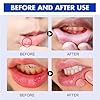 Mouth U-lcer Treatment,S-ore Mouth and Tongue Treatment,C-Anker S-ore Treatment,Severe Mouth U-lcer Treatment,Mouth U-lcer Treatment for Adults,Dry Mouth Oral U-lcers Spray,Mouth Freshener Spray