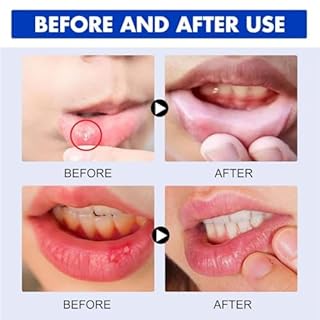 Mouth U-lcer Treatment,S-ore Mouth and Tongue Treatment,C-Anker S-ore Treatment,Severe Mouth U-lcer Treatment,Mouth U-lcer Treatment for Adults,Dry Mouth Oral U-lcers Spray,Mouth Freshener Spray