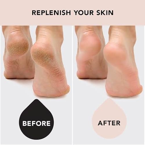 Kitsch Moisturizing Spa Socks - Gel Socks For Cracked Heel Repair | Heel Socks For Dry Cracked Feet | Dry Feet Treatment For Women | Cracked Feet Treatment | Toeless Socks For Women | Foot Care #TOP4