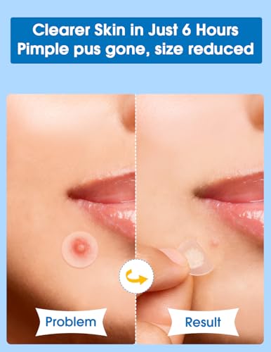 Pimple Patches for Face—Hydrocolloid Acne Patch, 6 Sizes (7/8/10/11/12/14 mm), 560 ct.—Tea Tree, Salicylic Acid & Centella-Invisible Waterproof Spot Dots, Absorb Fluid & Shrinking Zits and Whiteheads