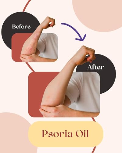 Image of Siya Ayurveda Psoriasis Oil for Scalp and Body
