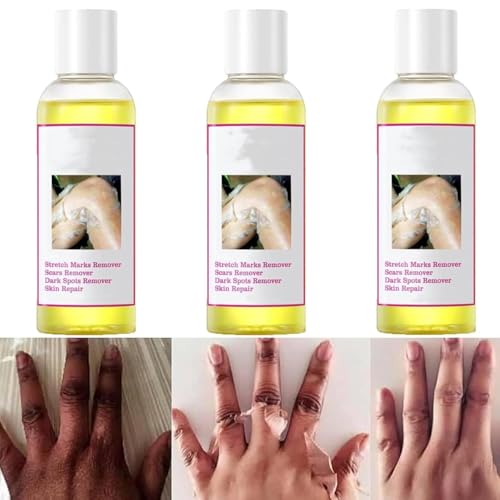 HMLZSJ Olio Peeling Giallo, Olio Peeling Forte per Pelle Scura, Extra Forte, Esfoliante per Corpo, Mani e Piedi, per Tutti i Tipi di Pelle, per Viso, Corpo, Mani, Piedi e Ginocchia