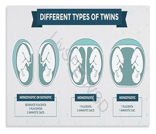 Clinic Office Decor Educational Canvas Wall Art Placentation of Twins Detailed Anatomy Chart for Home Hospital Decor(Unframed,08