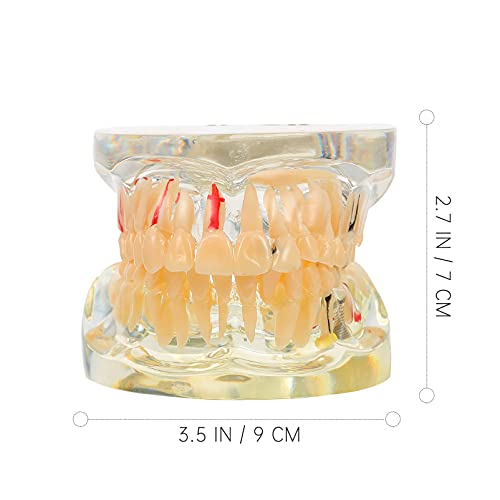 DOITOOL Tandheelkundig implantaat Tanden Model Transparante Volwassen Pathologieën Implantaat Demonstratie Tanden… - Image 7