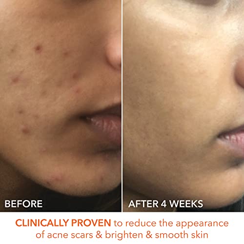 Dr. Dennis Gross Alpha Beta Extra Strength Daily Peel: for Oily Skin, Uneven Tone or Texture, Wrinkles or Enlarged Pores (30 Treatments)