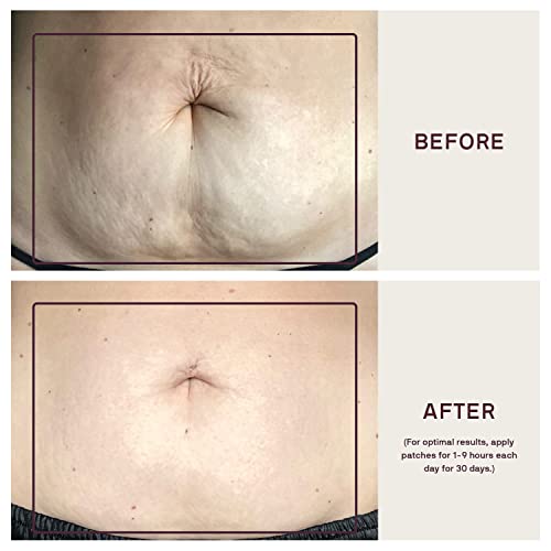 Dermaclara Patch de corpo grande - Prevenção e remoção de estrias na gravidez, folha de cicatriz de
