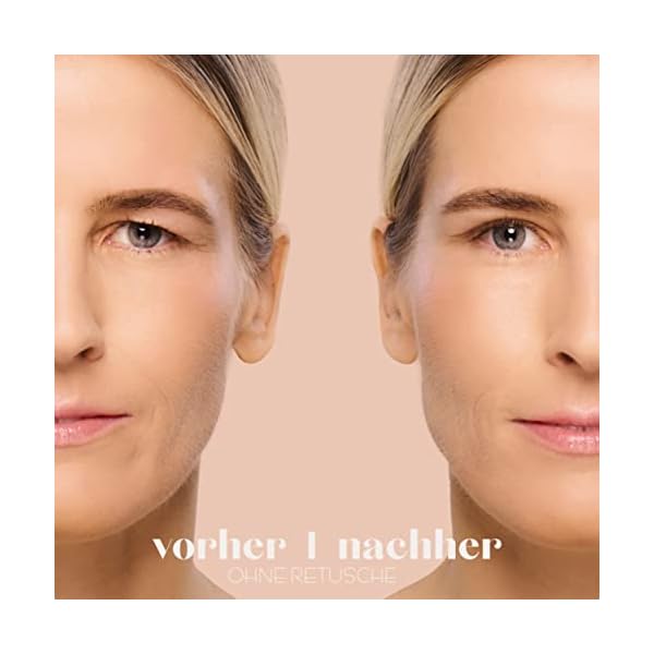 BOTÉ 144 Schlupflider Stripes zur Lidstraffung ohne OP (Größe L) - Dermatest"sehr gut" - atmungsaktive Mash Technologie - Augenlid Stripes unsichtbar – Bild 4