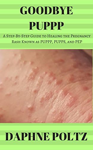 Pupspp Rash Goodbye PUPPP: A Step-by-Step Guide to Healing the Pregnancy Rash Known ...