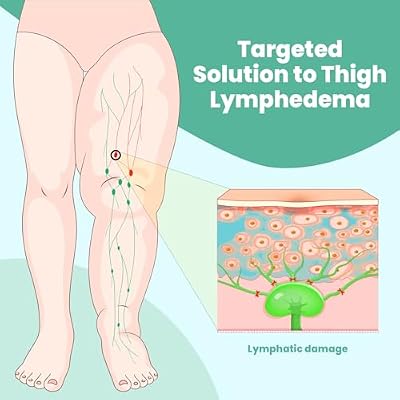 iDonua Swollen Thigh Compression Wrap Brace for Lymphedema Reduction - with Adjustable 4 Cross Straps (Tall-M)