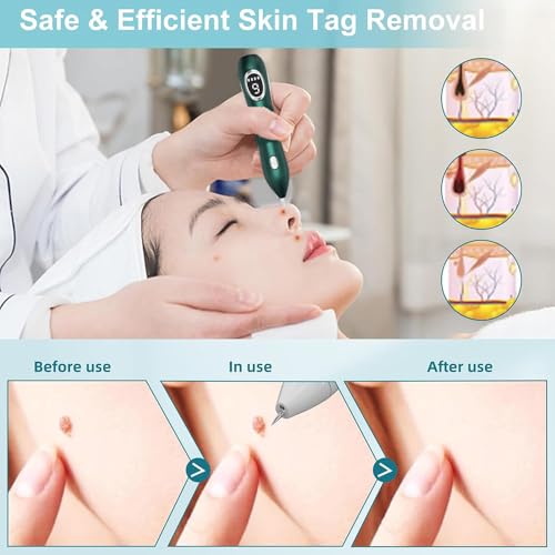 Removedor de etiquetas de pele, caneta de remoção de toupeira, ajuste de nove velocidades e visor LC