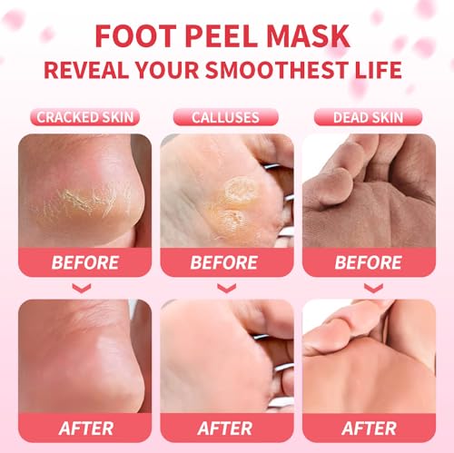 Foot Peeling Mask 5 Pairs - Foot Mask for Dry Cracked Feet, Feet Peeling Masks that Remove Dead Skin for Soft Heels (Peach) - Image 4