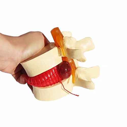 BoNew-Oral Anatomical Human Lumbar disc herniation Demonstration Model Human Spine Yellow Color