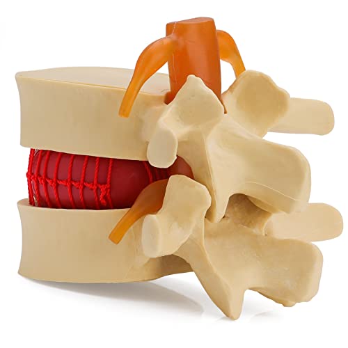LVCHEN Disc Herniation Model - Human Lumbar Disc Herniation Spine Model 1.5X Intervertebral Disc Model Anatomical Vertebrae Disc Model with Elastic Software