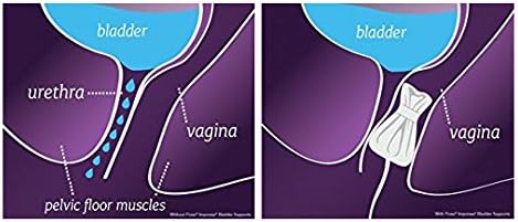 Poise Impressa Incontinence Bladder Supports Sizing Kit, Sizes 1,2,3 (6 count)