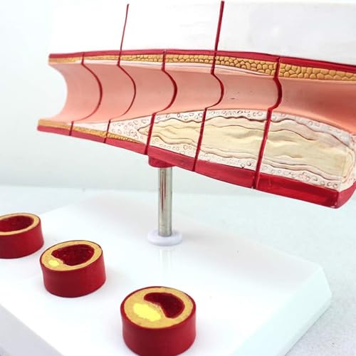 Modèle vasculaire de thrombose AMITD numéroté pour cours médicaux - 3