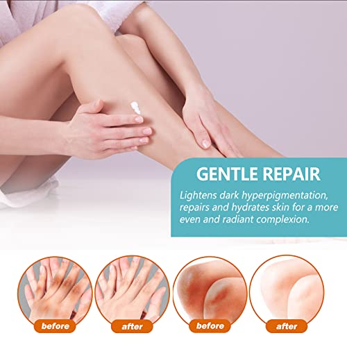 2Pcs Acanthosis Nigricans Therapy Cream,Cream For Acanthosis Nigricans With Lactic Acid,Removal Of Hyperpigmentation,For Dark Body Parts Like Neck, Ankles, Knuckles, Armpits, Thighs & Elbows #TOP3