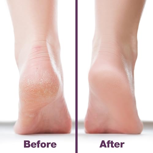 Image of Probelle Double Sided Multidirectional Nickel Foot File Callus Remover - Immediately Reduces calluses and Corns to Powder for Instant Results, Safe Tool (Purple)