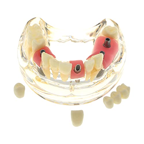 Dental Implant Teeth Model Demo 4 Implants Bridge Abutment Overdenture Typodont Restoration Study Teach Demo Soft Gingivae Crowns (M2005) #TOP7