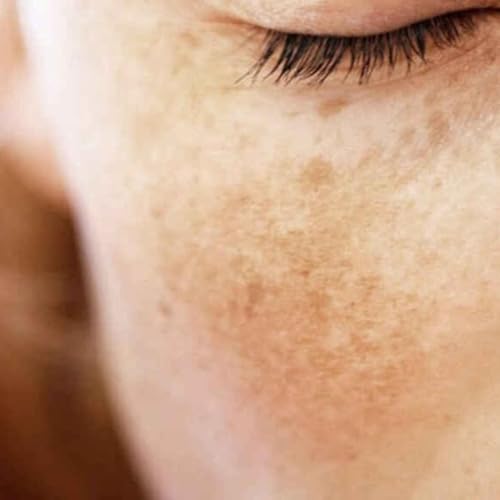 NOVEDAD EN TRATAMIENTO DEL MELASMA, con Dra. Helga Rivera