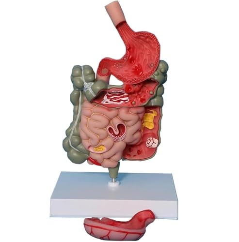 Pathologie intestine anatomie humaine grand modèle amovible