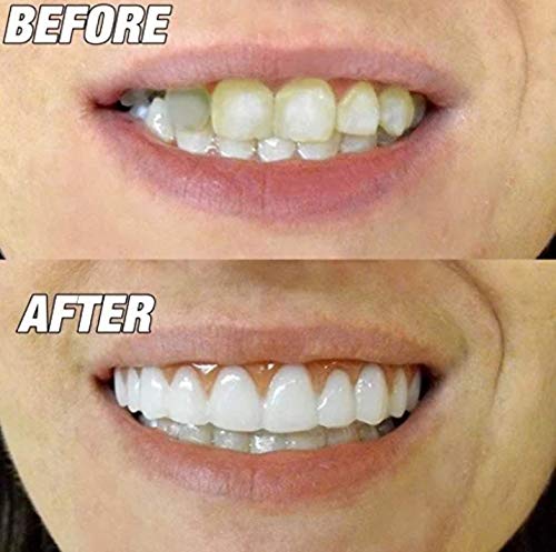 Upper Temporary Flexible Tooth Dentures For A Nice Smile Male & Female Medium Size