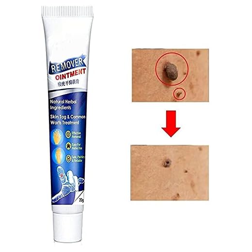 Eliminación de verrugas Crema para el tratamiento de las verrugas corporales Crema para el cuidado de los pies Eliminador de etiquetas en la piel, Ungüento para verrugas plantares (1 piezas)