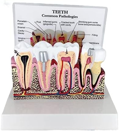 Model Zębów Próchnicy, Model Zębów Dentystycznych Do Badania Anatomii Zębów Dentystycznych, Edukacji Lekarza-pacjenta I Higieny Jamy Ustnej,Serene16