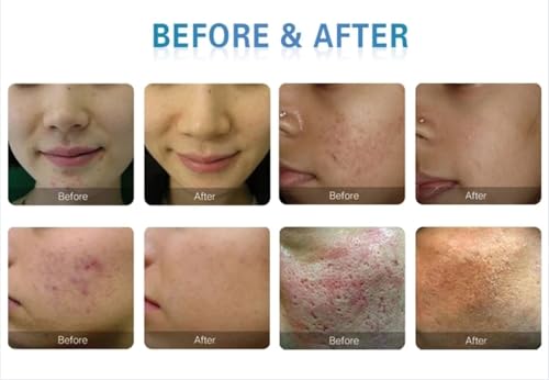 2 in 1 Professional Skin Care Machine,Improves Skin Elasticity Equipment, Reduces Age Spots, Relieves Redness and Sensitivity Instruments, and Enhances Skin Elasticity Machines - Image 8