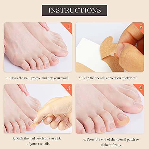 Rmisodo 120 Pieces Ingrown Toenail Correction Sticker, Adhesive Toenail Patch, Elastic Nail Treatment Corrector Sticker, Professional Foot Care Tools For Men - Keep Nails Healthy #TOP5