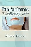 Natural Acne Treatments: The Best Homemade Remedies For Acne Damaged Skin