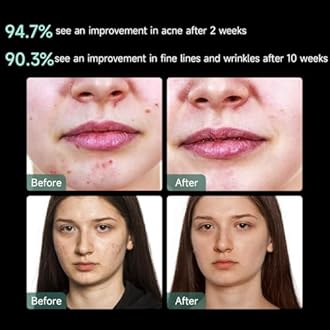 Aphrona® | FDA cleared Moonlight LED Facial Mask Skin Care Mask, LED Light Therapy Red Blue light for Acne Removal Wrinkle Reduction