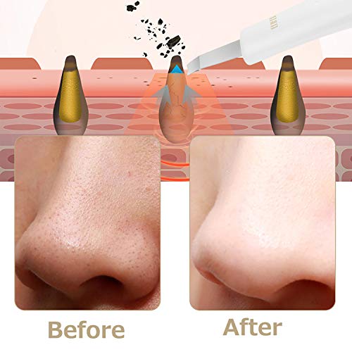 Skin Scrubber, Ultrasonic Pore Cleaner Blackhead Remover, Facial Scrubber Spatula, Comedones Extractor Rechargeable Face Lifting Tool with 3 modes for Facial Deep Cleansing - Thumbnail 6