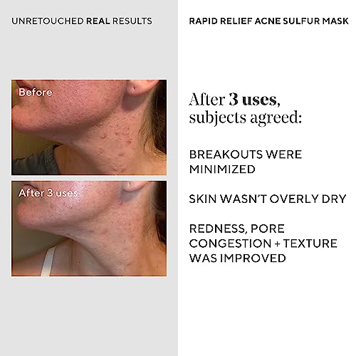Murad Rapid Relief Acne Sulfur Mask, view 5