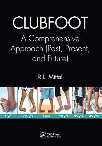 Clubfoot: A Comprehensive Approach (Past, Present, and Future)