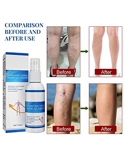 AHSRW Veinfix Varicose Treatment Spray,Veinfix