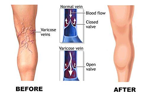 Mgang Compression Socks, 15-20 Mmhg Graduated Knee High Compression Stockings For Unisex, Class I, Open Toe, Opaque, Support Hose For Dvt, Pregnancy, Varicose Veins, Relief Shin Splints, Black L #TOP6