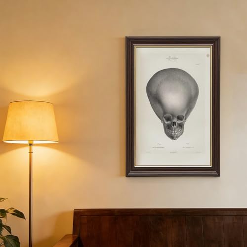 Toile crâne d'hydrocéphalie Joseph Vimont cadre suspendre 20x30cm - 4