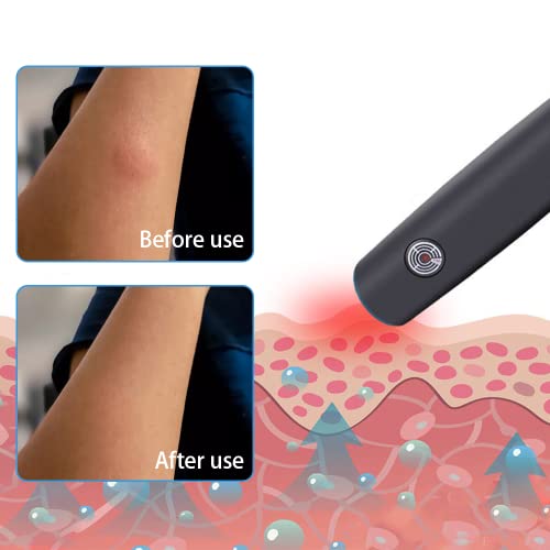 Sutify Insect Sting And Bite Relief, Electronic Mosquito Bites Itching Treatment Tool, Reduce Pain & Itching Chemical-Free Treatment Safe #TOP2
