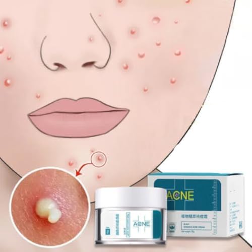 Crema Para El Acne ELIMINA Barros Espinillas Y Manchas RECUPERA Tu Piel LINDA