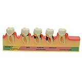 Easyinsmile Periodontal Disease Assort Tooth Typodont Model Study Teaching Teeth Model