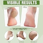 18 Pairs Moisturizing Foot Masks with Shea Butter, Jojoba Oil, Vitamin E & Urea, Intensely Hydrating Foot Mask For Dry Cracked Feet, Moisturizing Socks for Cracked Heel Treatment - Image 3