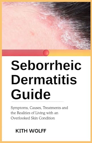 Seborrheic Dermatitis Guide: Symptoms, Causes, Treatments, and the Realities of Living with an Overlooked Skin Condition