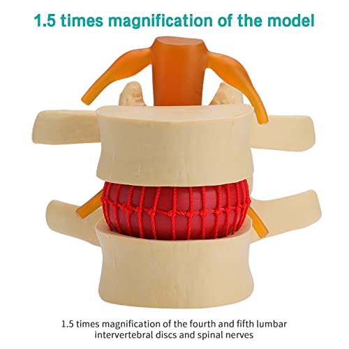 Image of Disc Herniation Model - Human Lumbar Disc Herniation Spine Model 1.5X Intervertebral Disc Model Anatomical Vertebrae Disc Model with Elastic Software