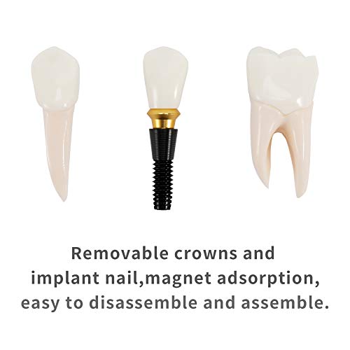 Annhua 4 Times Dental Implant Teeth Model Analysis Crown Bridge Demonstration Model, Dental Teeth Crown Roots Removable For Education, Patients Communication, Learning And Lab #TOP2