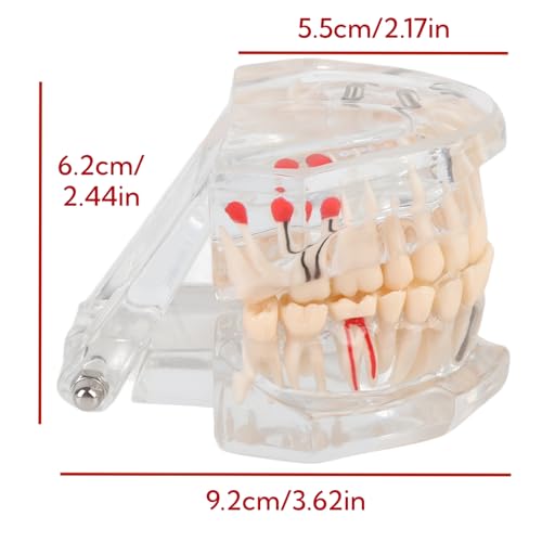 Natudeco Zahnmodell Dentalmodell Zahnkrankheits-Lehrmodell transparent, Demonstrationszahnmodell Zähneputzen, Zahnseide orales pathologisches Modell für den Schulunterricht, Forschung
