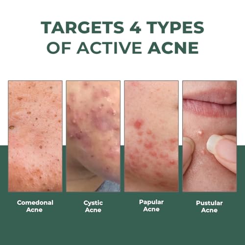 Image of Conscious Chemist Rapid Relief Acne Spot Corrector Gel | 15g | Triple-Action Treatment with 2% Salicylic Acid & Azelaic Acid | Clears Pimples, Reduces Redness & Fades Dark Spots | For Men & Women