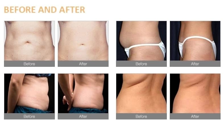 Amazon.co.jp: クリオリポリシスマシン 脂肪冷凍マシン 脂肪凍結処理